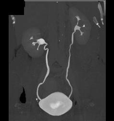 CT Urogram - CTisus CT Scan