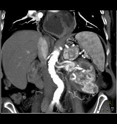 Renal Cell Carcinoma With Neovascularity and Renal Vein Invasion - CTisus CT Scan