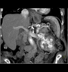 Renal Cell Carcinoma With Neovascularity and Renal Vein Invasion - CTisus CT Scan