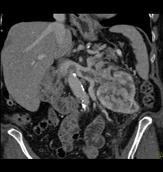 Renal Cell Carcinoma With Neovascularity and Renal Vein Invasion - CTisus CT Scan