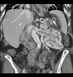 Renal Cell Carcinoma With Neovascularity and Renal Vein Invasion - CTisus CT Scan