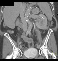 Renal Cell Carcinoma With Neovascularity and Renal Vein Invasion - CTisus CT Scan