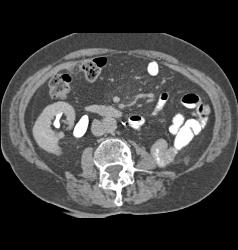 Left Nephrectomy - CTisus CT Scan