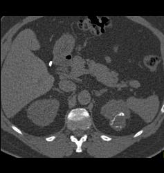 Complex Left Renal Cyst - CTisus CT Scan