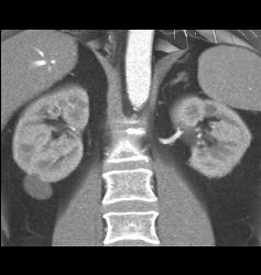 Complex Left Renal Cyst - CTisus CT Scan