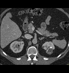 Complex Left Renal Cyst - CTisus CT Scan