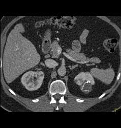 Complex Left Renal Cyst - CTisus CT Scan