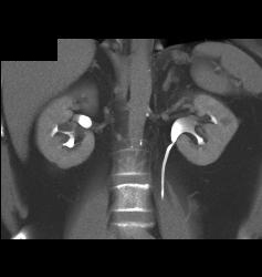 Complex Left Renal Cyst - CTisus CT Scan