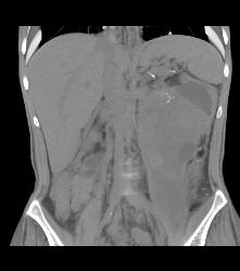 Hypervascular Left Renal Cell Carcinoma With Neovascularity - CTisus CT Scan