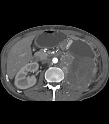 Hypervascular Left Renal Cell Carcinoma With Neovascularity - CTisus CT Scan