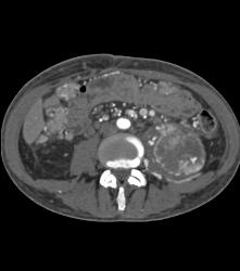 Hypervascular Left Renal Cell Carcinoma With Neovascularity - CTisus CT Scan