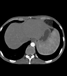 Hypervascular Left Renal Cell Carcinoma With Neovascularity - CTisus CT Scan