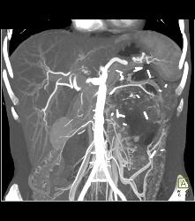 Hypervascular Left Renal Cell Carcinoma With Neovascularity - CTisus CT Scan