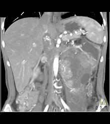 Hypervascular Left Renal Cell Carcinoma With Neovascularity - CTisus CT Scan