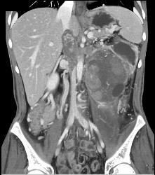 Hypervascular Left Renal Cell Carcinoma With Neovascularity - CTisus CT Scan