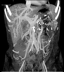 Hypervascular Left Renal Cell Carcinoma With Neovascularity - CTisus CT Scan