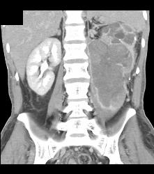 Hypervascular Left Renal Cell Carcinoma With Neovascularity - CTisus CT Scan