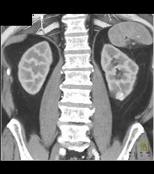 1 Cm Renal Cell Carcinoma Lower Pole Left Kidney - CTisus CT Scan