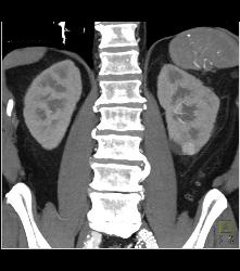 1 Cm Renal Cell Carcinoma Lower Pole Left Kidney - CTisus CT Scan