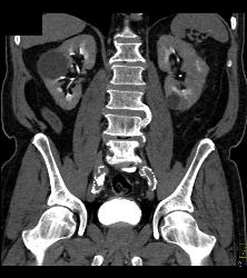 Complex Cyst Left Kidney - CTisus CT Scan