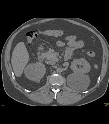 Left Renal Cell Carcinoma - CTisus CT Scan