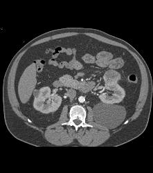 Left Renal Cell Carcinoma - CTisus CT Scan