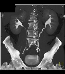 Left Renal Cell Carcinoma - CTisus CT Scan