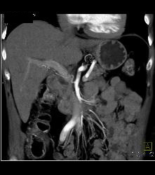 Nodal Mass Near Left Kidney- See Sequence - CTisus CT Scan