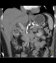 Nodal Mass Near Left Kidney- See Sequence - CTisus CT Scan