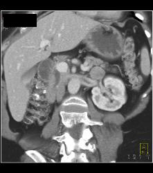 Nodal Mass Near Left Kidney- See Sequence - CTisus CT Scan