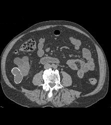 Calcified Cystic Right Renal Mass- Benign - CTisus CT Scan