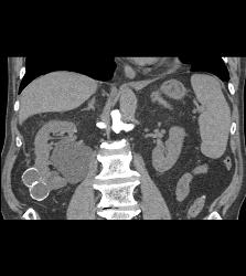 Calcified Cystic Right Renal Mass- Benign - CTisus CT Scan