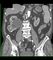 Calcified Cystic Right Renal Mass- Benign - CTisus CT Scan