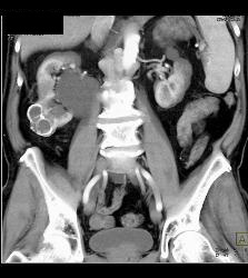 Calcified Cystic Right Renal Mass- Benign - CTisus CT Scan