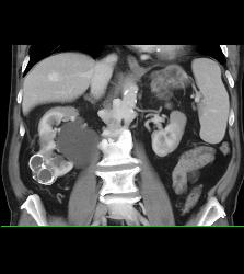 Calcified Cystic Right Renal Mass- Benign - CTisus CT Scan