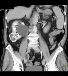 Calcified Cystic Right Renal Mass- Benign - CTisus CT Scan