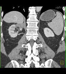 Radiofrequency Ablation (RFA) Changes in Upper Pole of Right Kidney- Looks Like Infarct - CTisus CT Scan