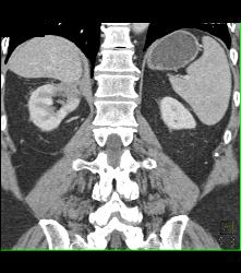 Radiofrequency Ablation (RFA) Changes in Upper Pole of Right Kidney- Looks Like Infarct - CTisus CT Scan