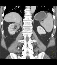 Radiofrequency Ablation (RFA) Changes in Upper Pole of Right Kidney- Looks Like Infarct - CTisus CT Scan