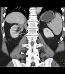 3D of Calyces of Left Kidney - CTisus CT Scan