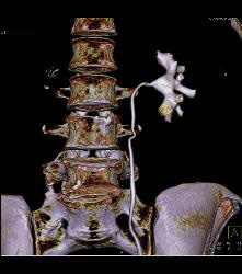 3D of Calyces of Left Kidney - CTisus CT Scan