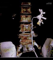 Renal Cell Carcinoma With Vascular Bone Metastases - CTisus CT Scan