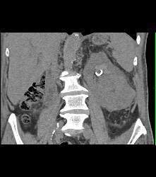 Renal Cell Carcinoma With Vascular Bone Metastases - CTisus CT Scan