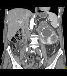 Renal Cell Carcinoma With Vascular Bone Metastases - CTisus CT Scan