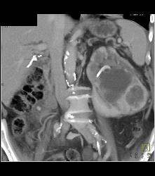 Renal Cell Carcinoma With Vascular Bone Metastases - CTisus CT Scan