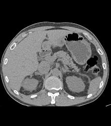 Vascular Right Renal Cell Carcinoma Invades the Renal Veins and the IVC - See Full Sequence - CTisus CT Scan