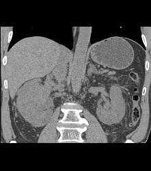 Vascular Right Renal Cell Carcinoma Invades the Renal Veins and the IVC - See Full Sequence - CTisus CT Scan