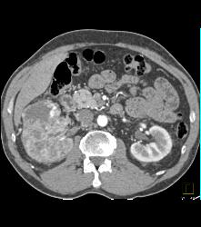 Vascular Right Renal Cell Carcinoma Invades the Renal Veins and the IVC - See Full Sequence - CTisus CT Scan