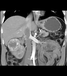 Vascular Right Renal Cell Carcinoma Invades the Renal Veins and the IVC - See Full Sequence - CTisus CT Scan