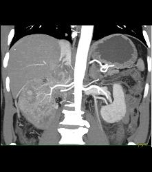 Vascular Right Renal Cell Carcinoma Invades the Renal Veins and the IVC - See Full Sequence - CTisus CT Scan